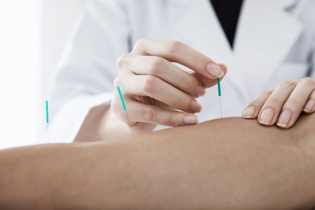 Close-up of acupuncture needles inserted in a person's skin.