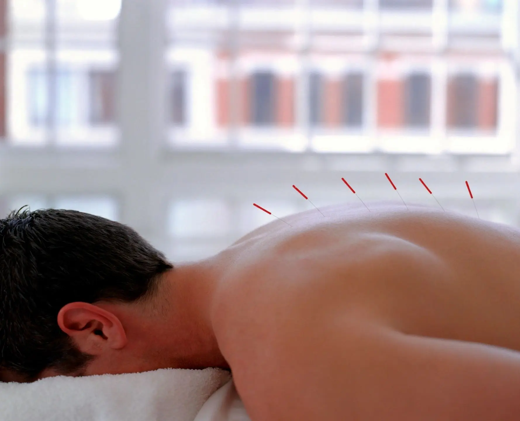 Person receiving acupuncture on their back.