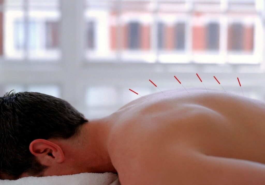 Person receiving acupuncture on their back.